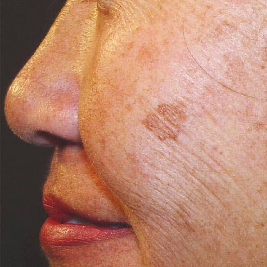Pigment Removal