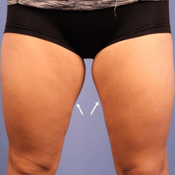 Woman exposes her inner thigh fat.