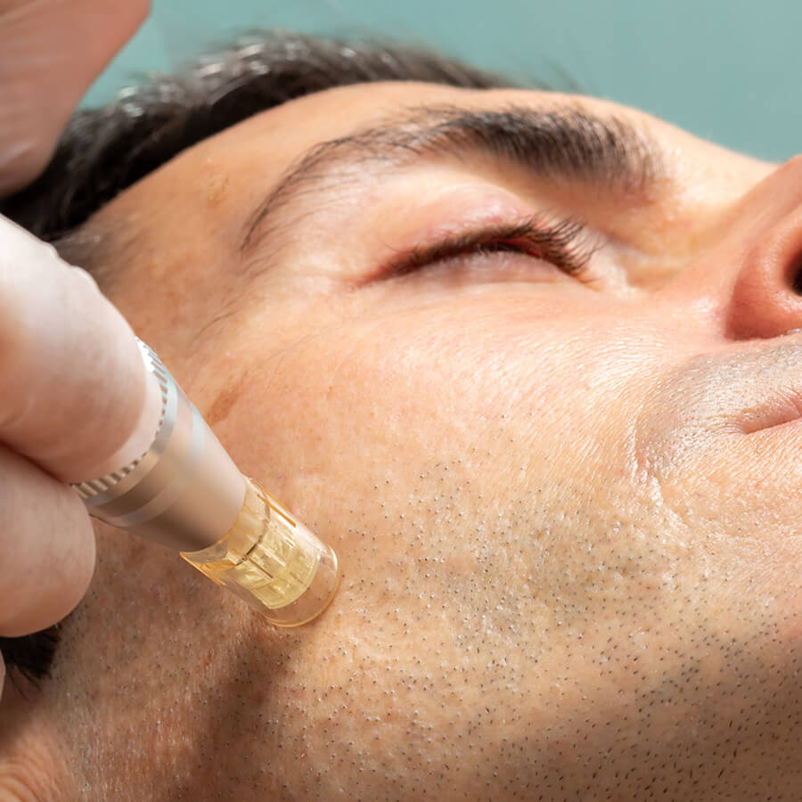 Aesthetician provides Microneedling for their client.