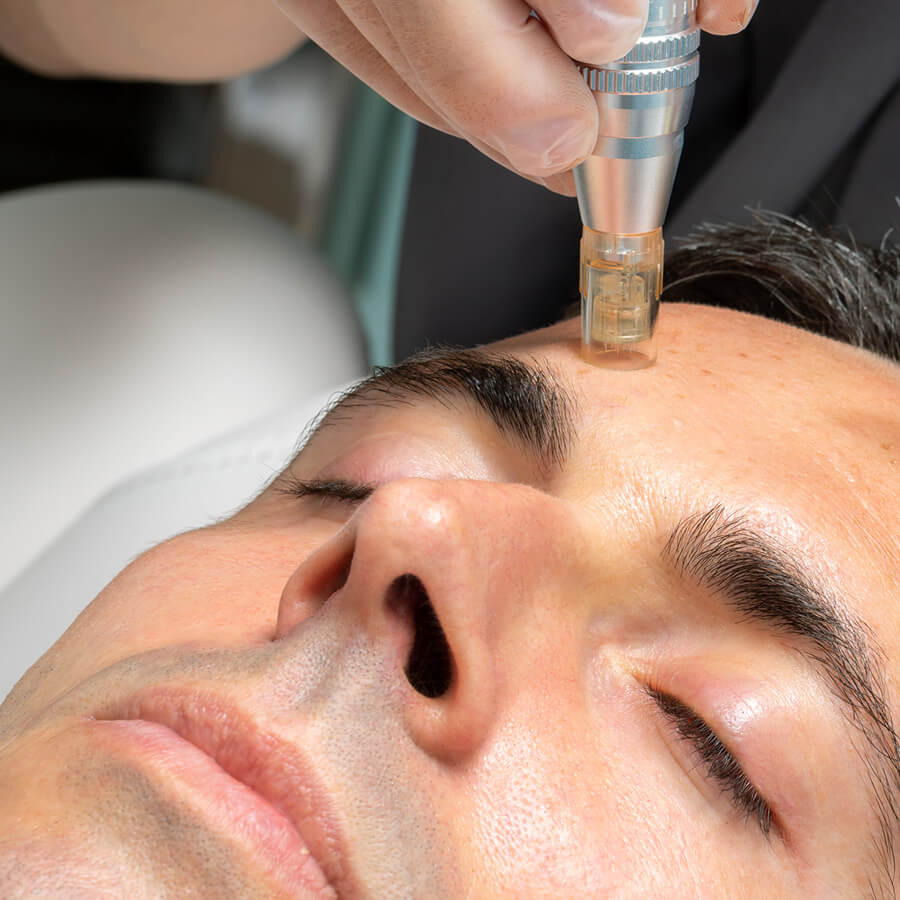 Aesthetician provides PRP Vampire Facial for their client.