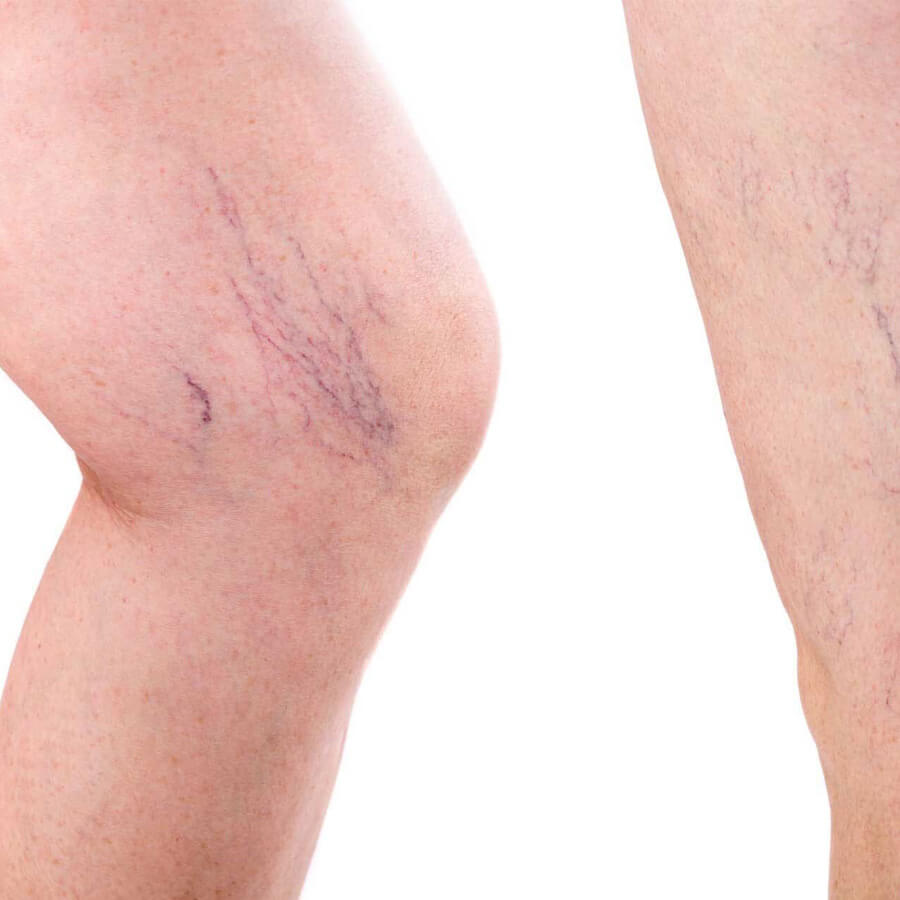 Spider veins on a woman's leg.